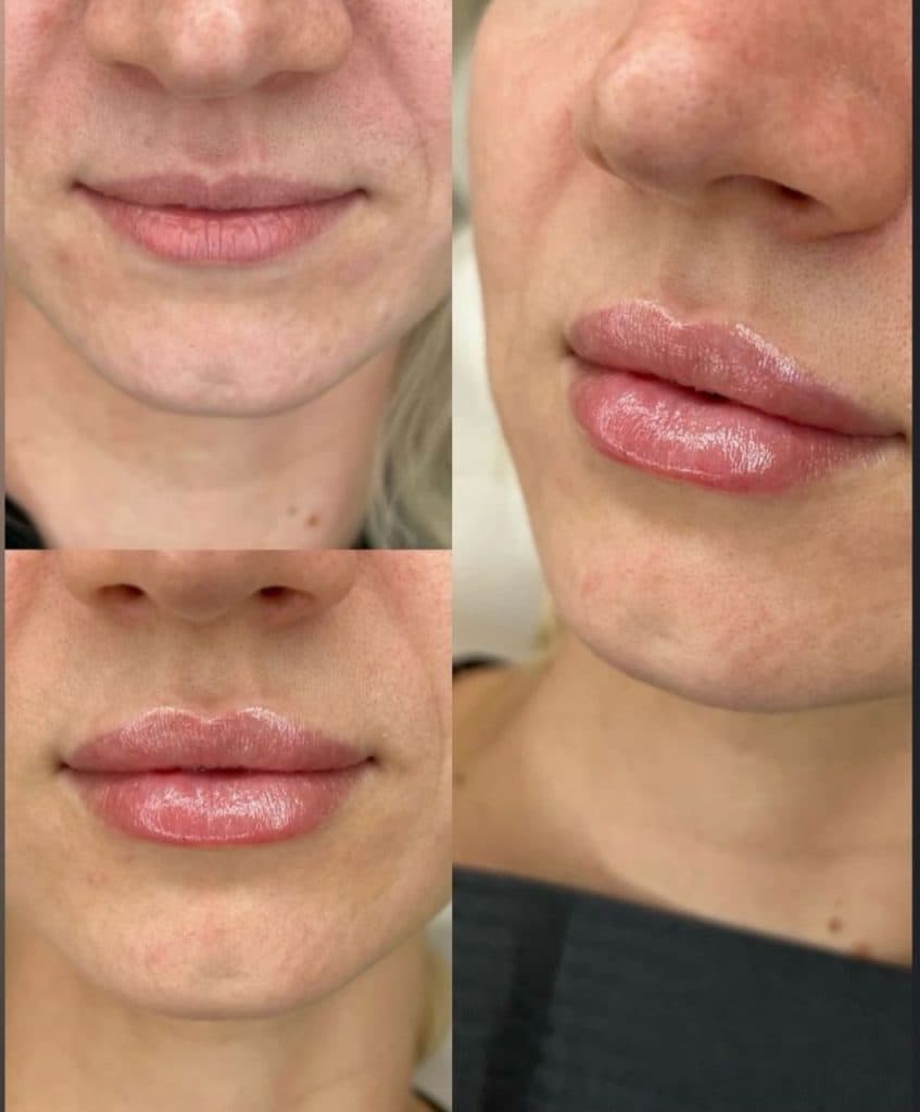 تزریق ژل لب روسی دکتر مریم فارسی در یاسوج