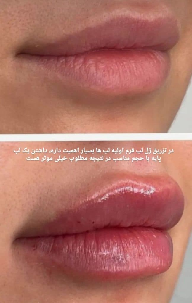 تزریق ژل لب روسی دکتر مریم فارسی در یاسوج