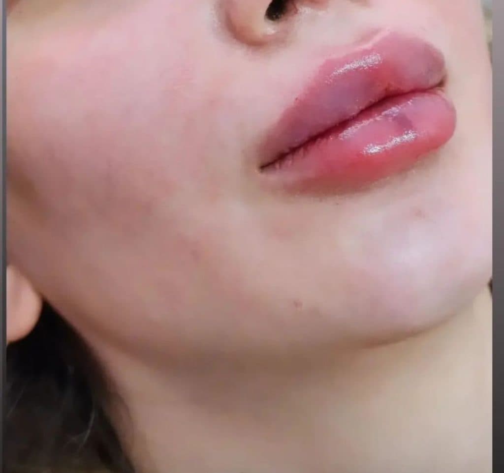 تزریق ژل لب روسی دکتر مریم فارسی در یاسوج