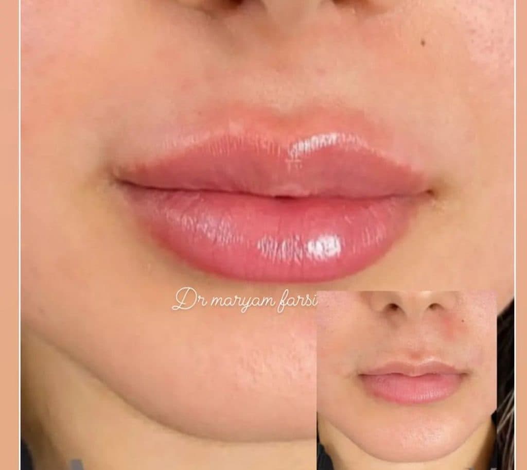 تزریق ژل لب روسی دکتر مریم فارسی در یاسوج