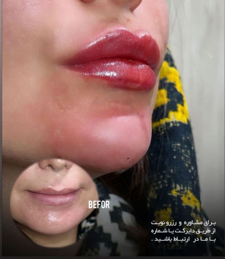تزریق ژل لب روسی دکتر مریم فارسی در یاسوج