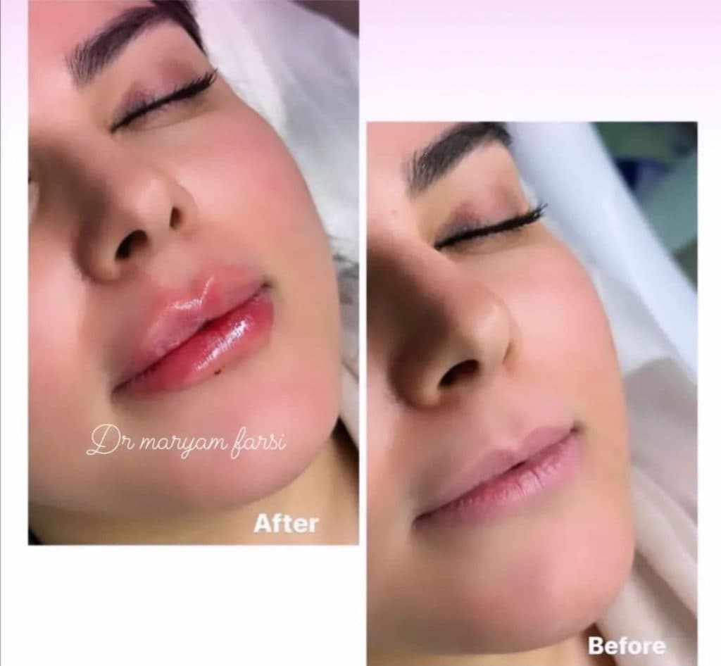 تزریق ژل لب روسی دکتر مریم فارسی در یاسوج