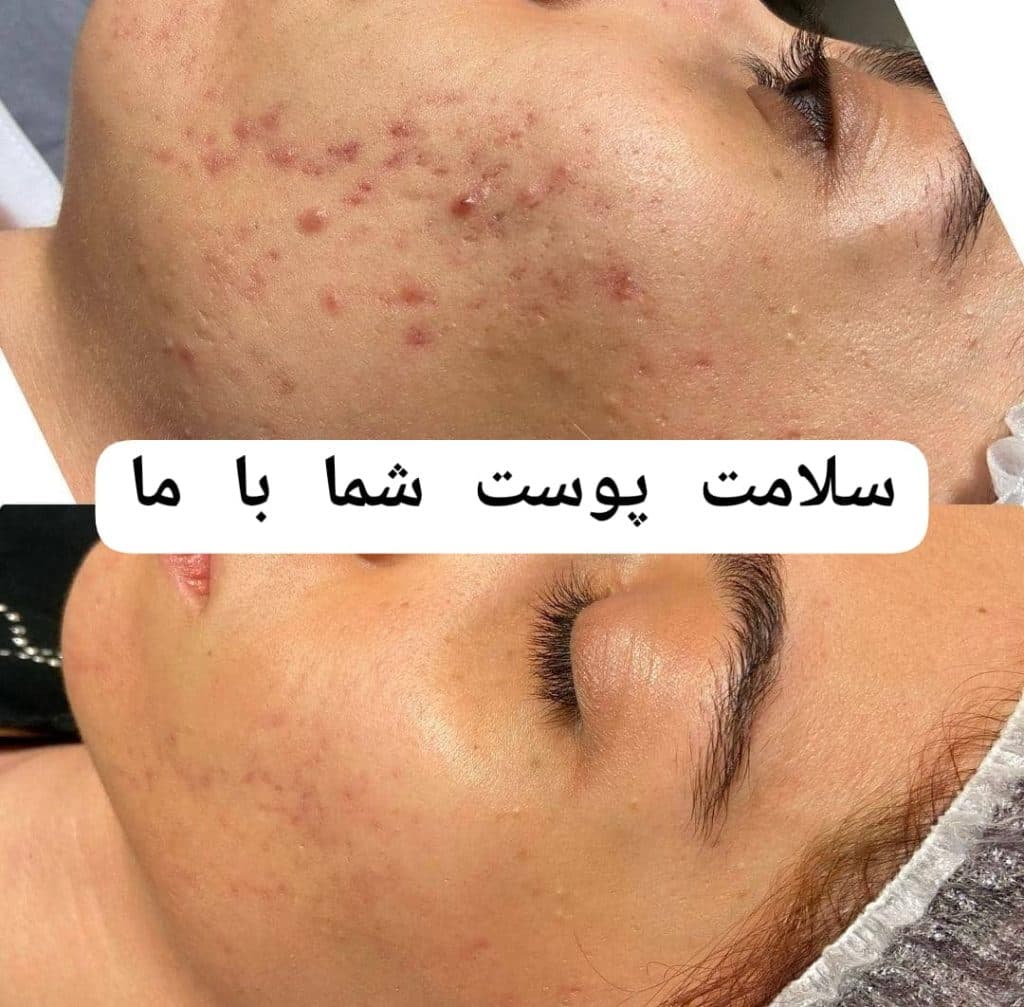 آموزش و خدمات تخصصی پاکسازی پوست پرین در شاهین شهر