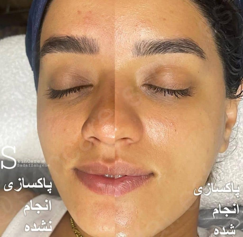 آموزش و خدمات تخصصی پاکسازی پوست صدف زنگنه در اصفهان