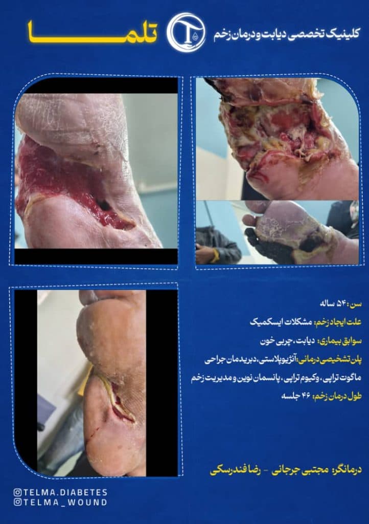 کلینیک تخصصی زخم دیابتی تلما در گرگان
