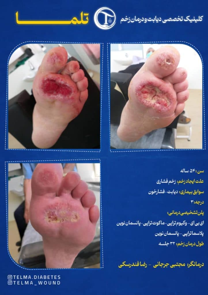 کلینیک تخصصی زخم دیابتی تلما در گرگان