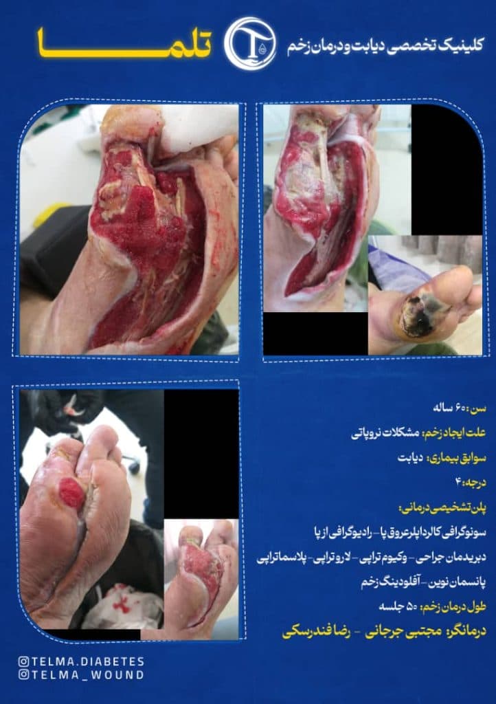 کلینیک تخصصی زخم دیابتی تلما در گرگان