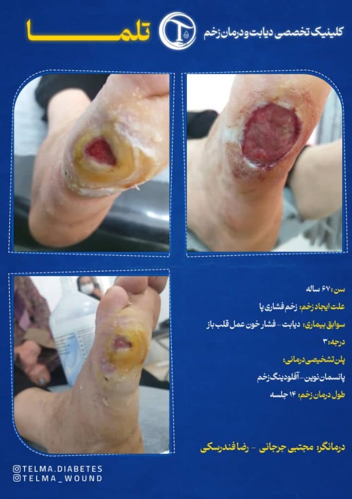 کلینیک تخصصی زخم دیابتی تلما در گرگان