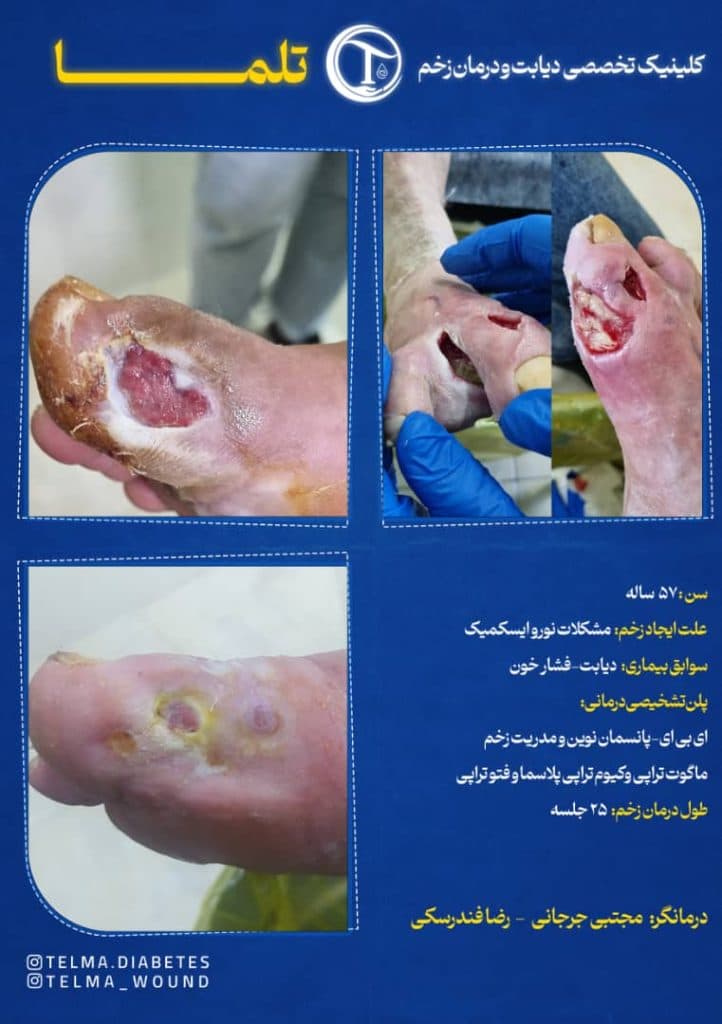 کلینیک تخصصی زخم دیابتی تلما در گرگان