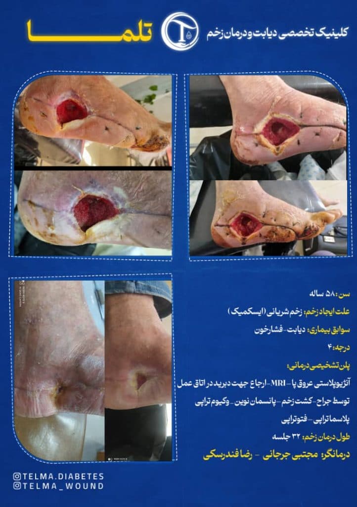 کلینیک تخصصی زخم دیابتی تلما در گرگان