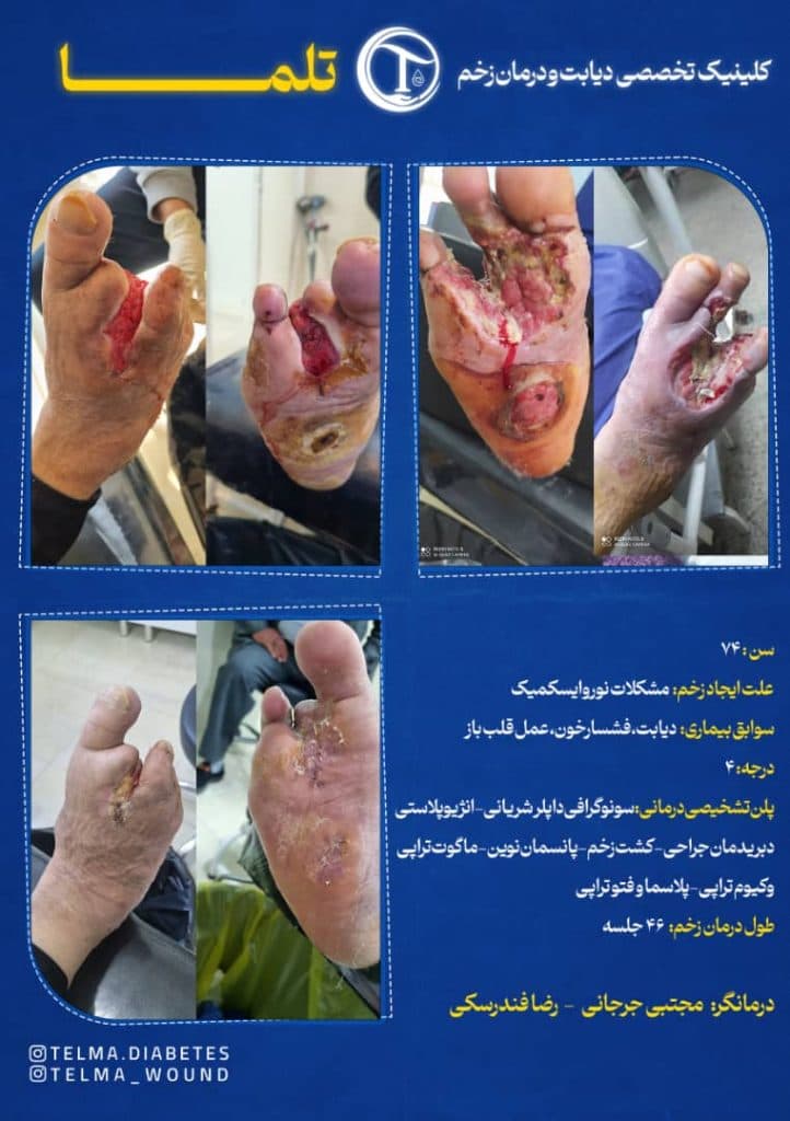 خدمات تخصصی درمان زخم بستر در منزل تلما در گرگان