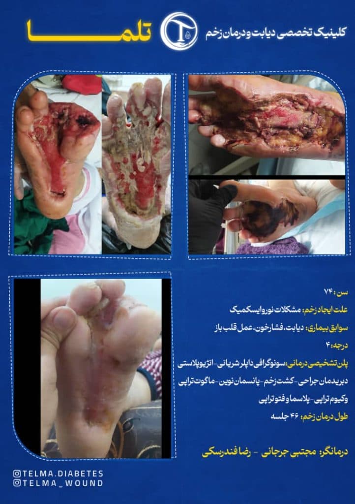 خدمات تخصصی درمان زخم بستر در منزل تلما در گرگان