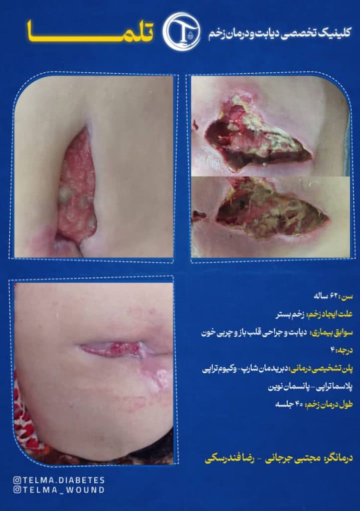 خدمات تخصصی درمان زخم بستر در منزل تلما در گرگان