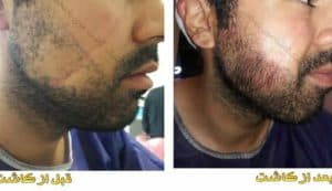 مرکز کاشت مو درمیس در کرمانشاه