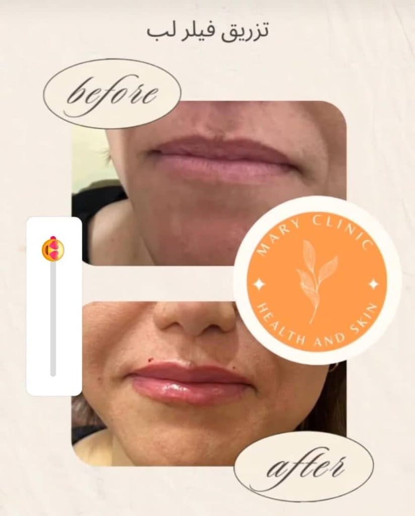 تزریق ژل لب کلینیک زیبایی ماری در غرب تهران