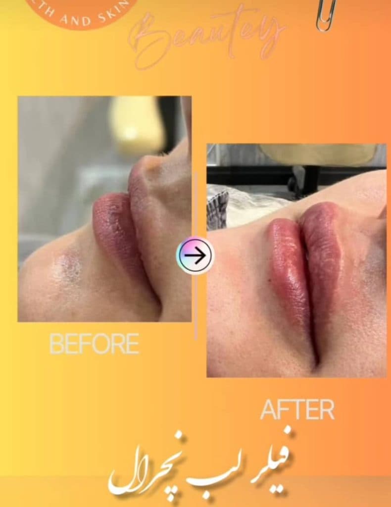 تزریق ژل لب کلینیک زیبایی ماری در غرب تهران