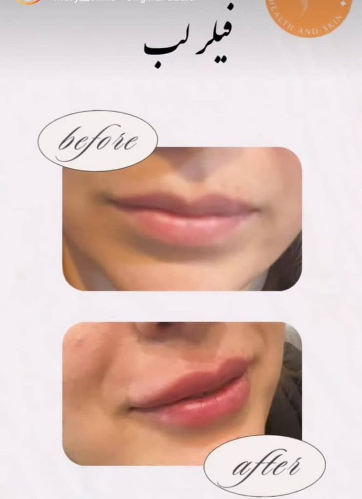 تزریق ژل لب کلینیک زیبایی ماری در غرب تهران