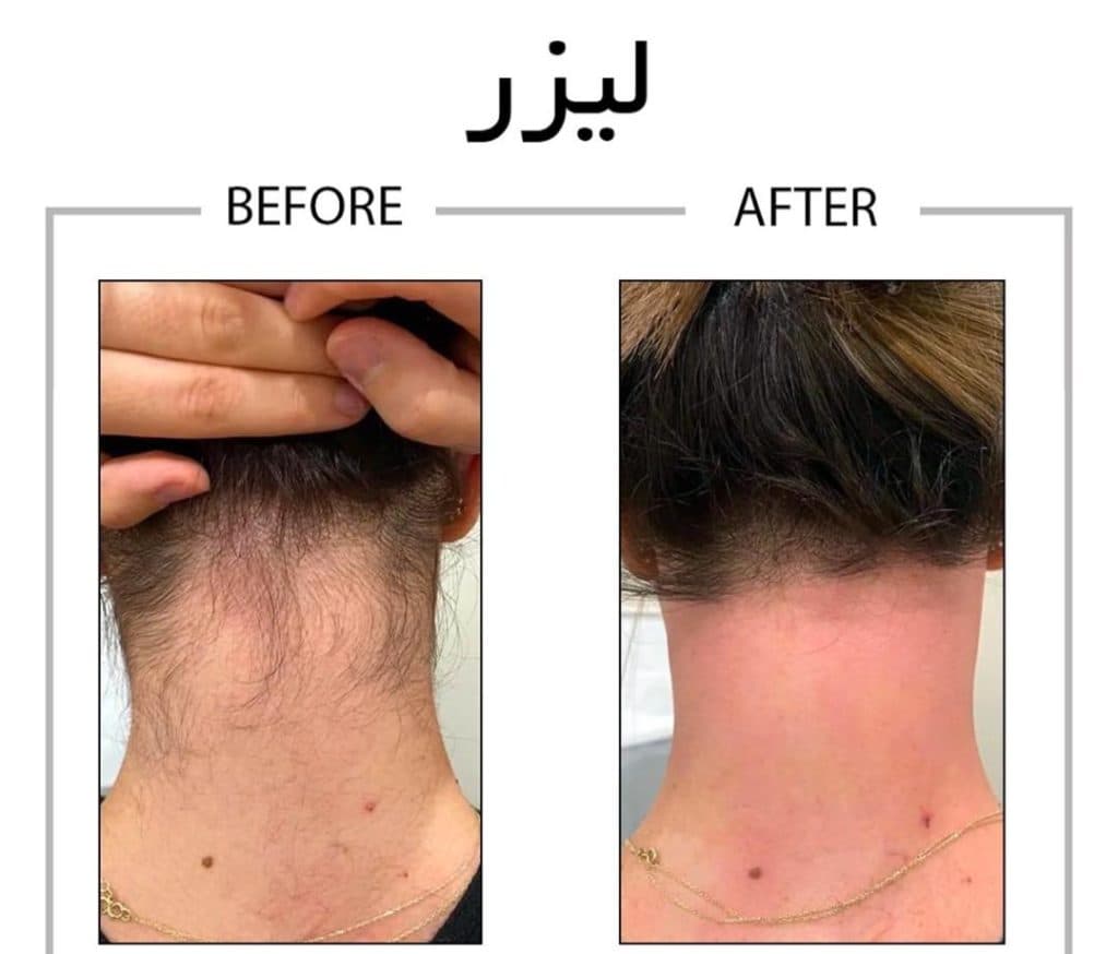 مرکز لیزر لاویتا در تهرانپارس غربی تهران