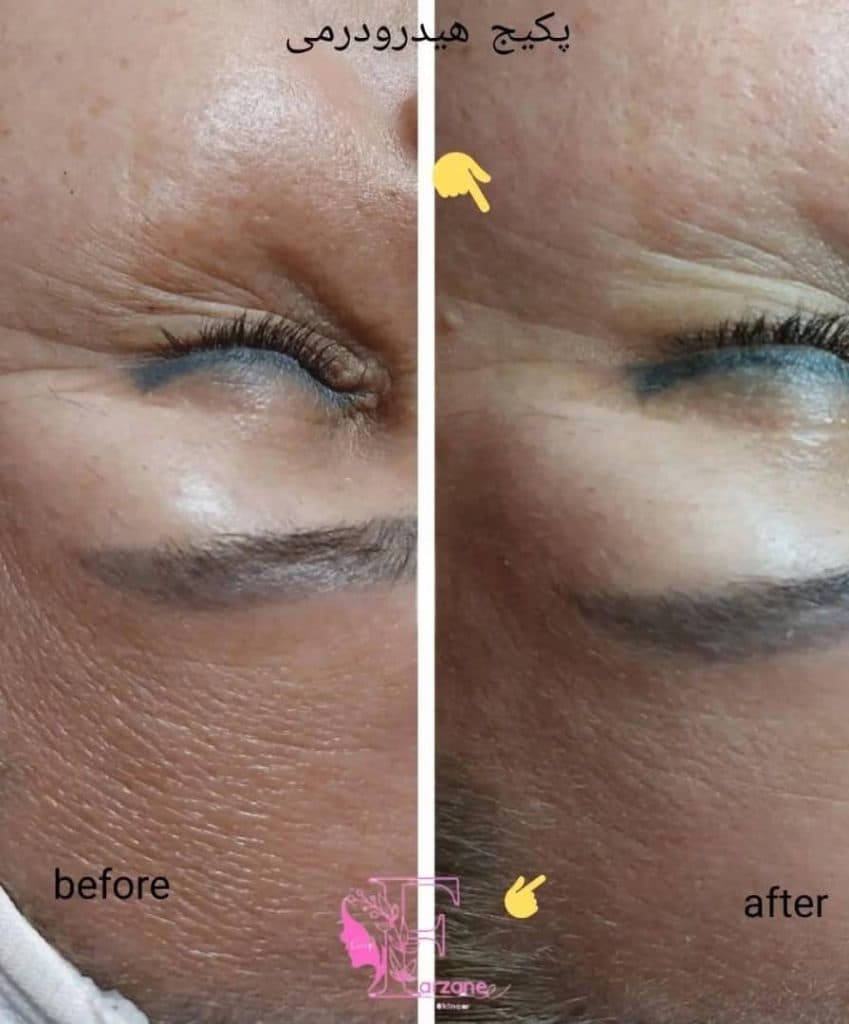 فیشال و پاکسازی پوست فرزانه در شیراز