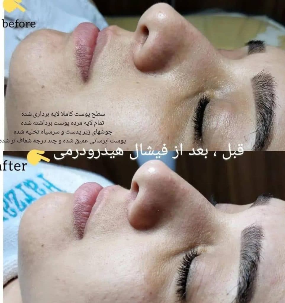 فیشال و پاکسازی پوست فرزانه در شیراز
