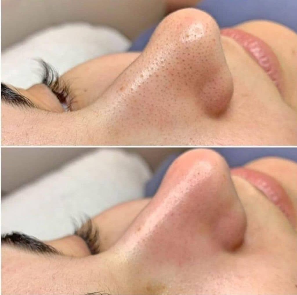 فیشال و پاکسازی پوست فرزانه در شیراز