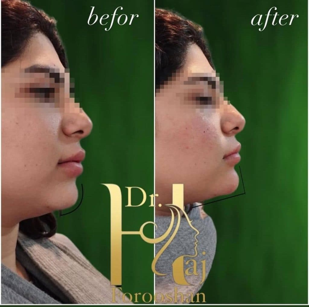 کلینیک تخصصی تزریق ژل و بوتاکس دکتر حج فروشان در خیام 46 مشهد