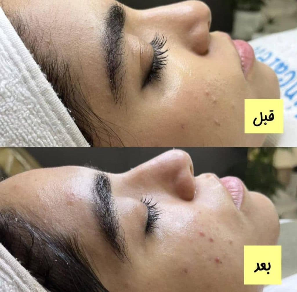 فیشال و پاکسازی پوست فرزانه در شیراز