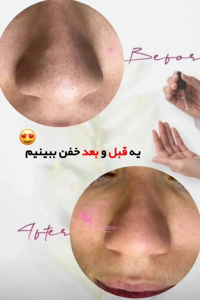 فیشال و پاکسازی پوست فرزانه در شیراز