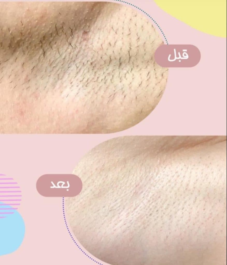 مرکز لیزر لاویتا در تهرانپارس غربی تهران