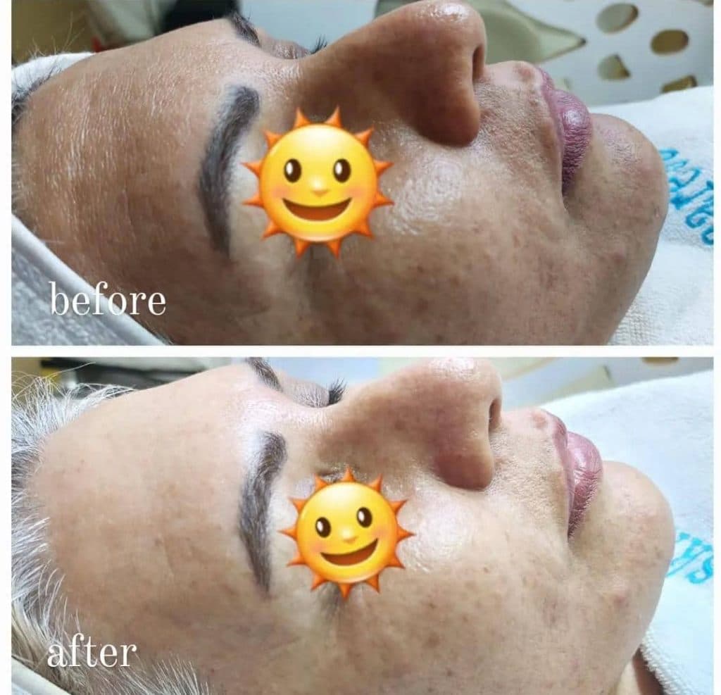 فیشال و پاکسازی پوست فرزانه در شیراز