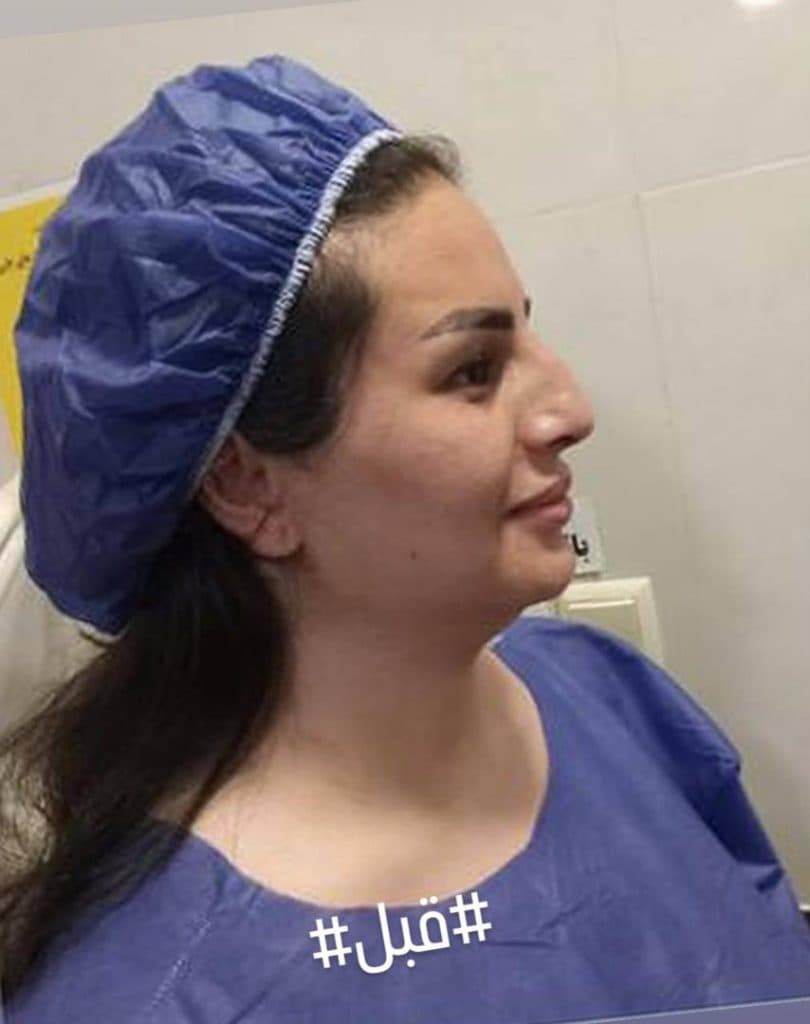 جراحی زیبایی بینی دکتر امیرحسین اسداله پور در قائمشهر