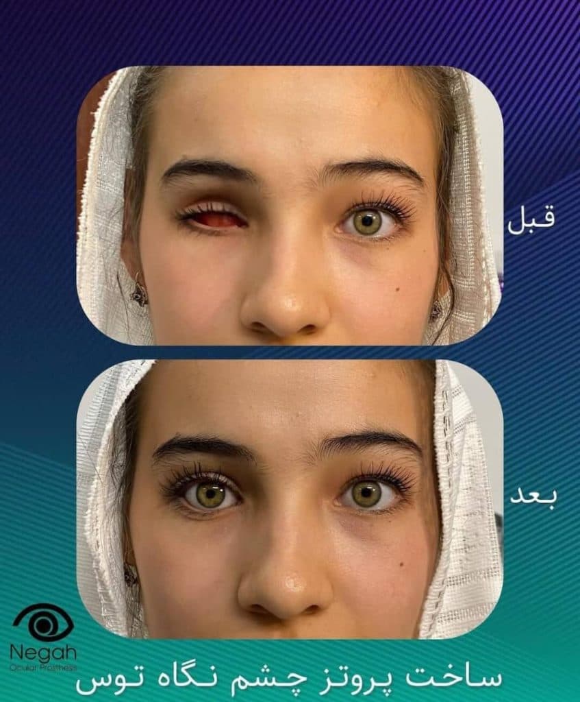 ساخت چشم مصنوعی نگاه توس در مرکز مشهد