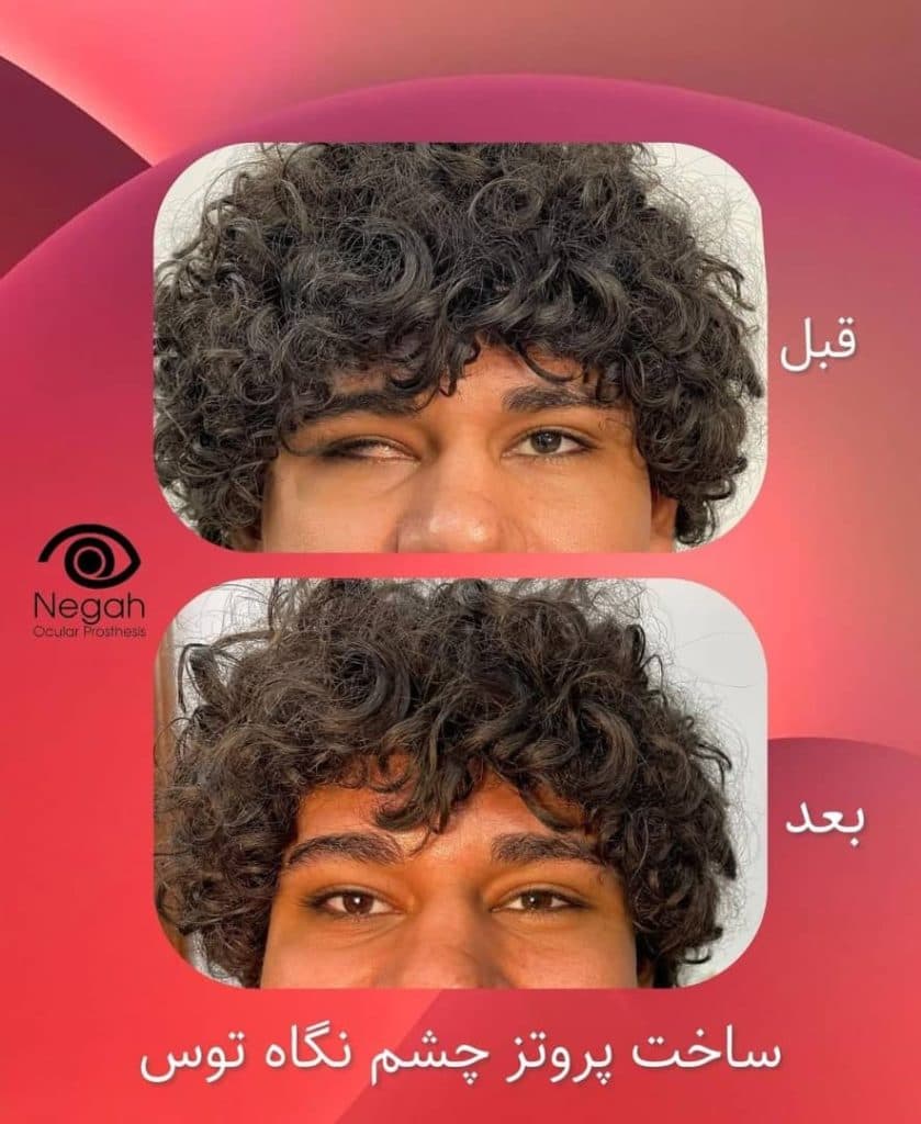ساخت چشم مصنوعی نگاه توس در مرکز مشهد
