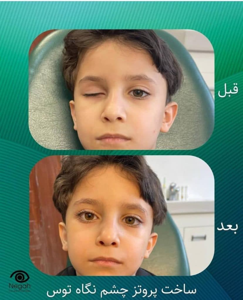 ساخت چشم مصنوعی نگاه توس در مرکز مشهد