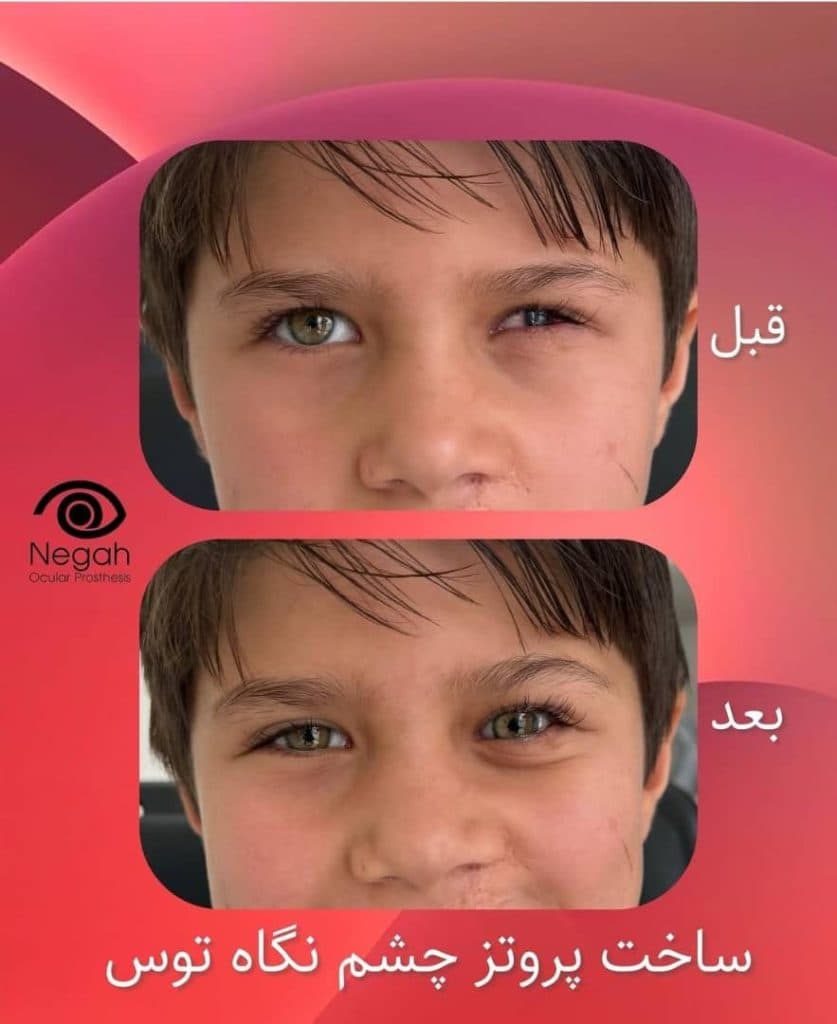 ساخت چشم مصنوعی نگاه توس در مرکز مشهد