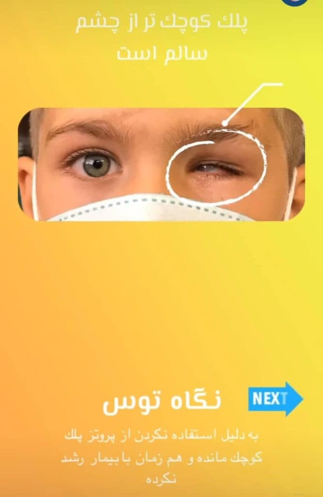 ساخت چشم مصنوعی نگاه توس در مرکز مشهد