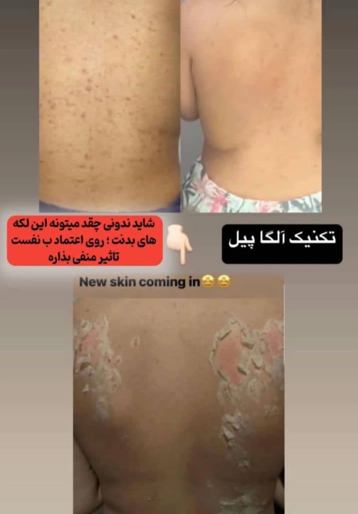 خدمات تخصصی فیشیال و پاکسازی پوست آزیتا زارع در صفاییه یزد