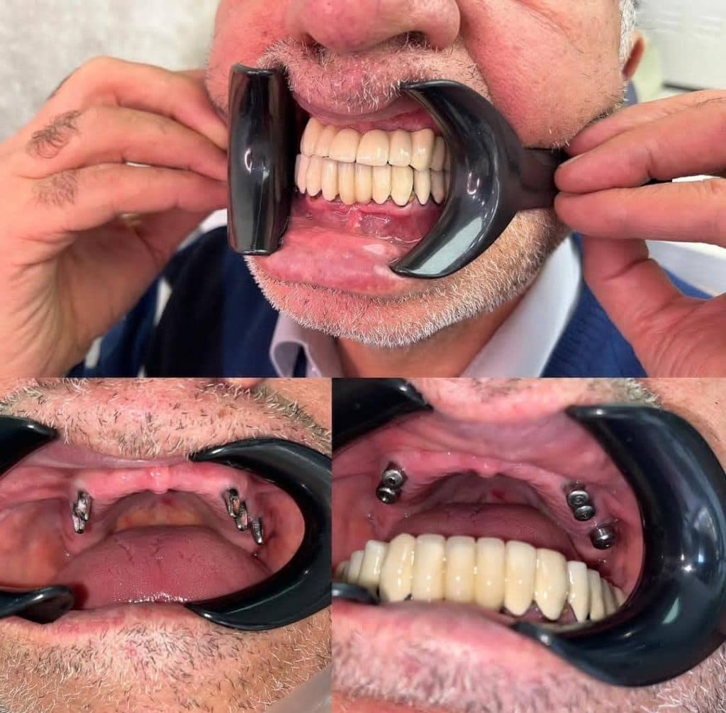 مرکز تخصصی ایمپلنت دندان دکتر منوچهر عابدی در ولیعصر تبریز