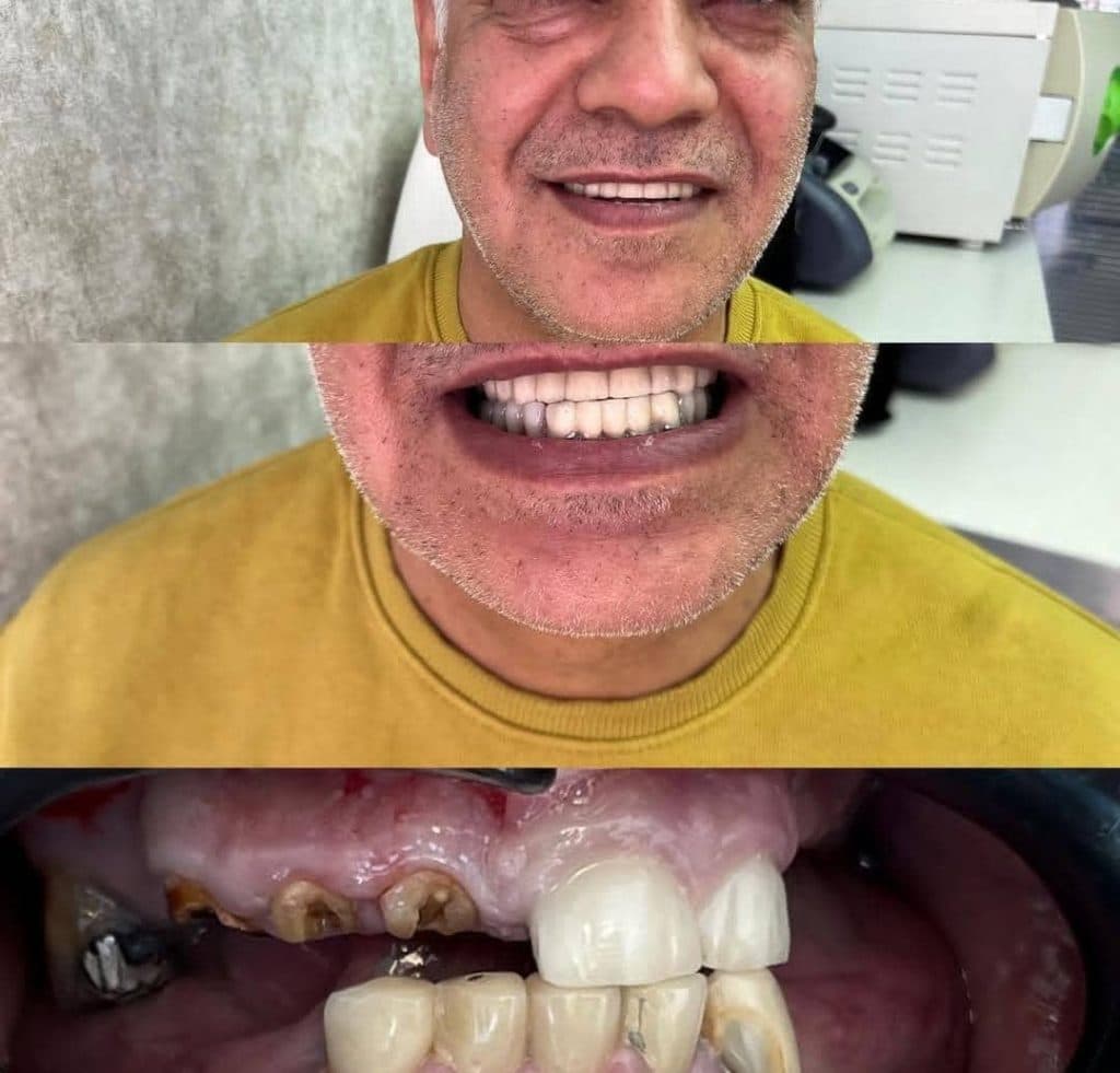 مرکز تخصصی ایمپلنت دندان دکتر منوچهر عابدی در ولیعصر تبریز