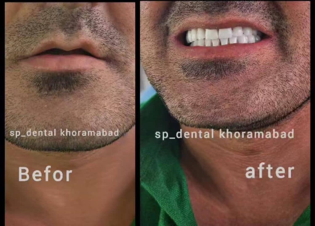 مرکز پروتز متحرک دندان اسپی دنتال در انقلاب خرم آباد