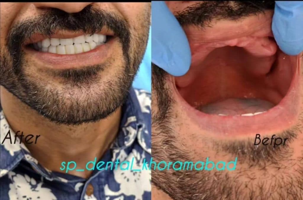 مرکز پروتز متحرک دندان اسپی دنتال در انقلاب خرم آباد