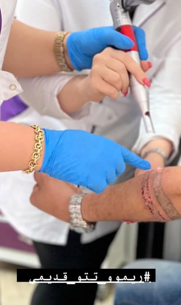 پاک کردن و ریمو تتو با لیزر رامونا لند در تهرانپارس تهران