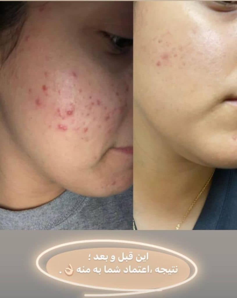 آموزش و خدمات تخصصی پاکسازی پوست و فشیال صورت هدیه تقویان در مشهد