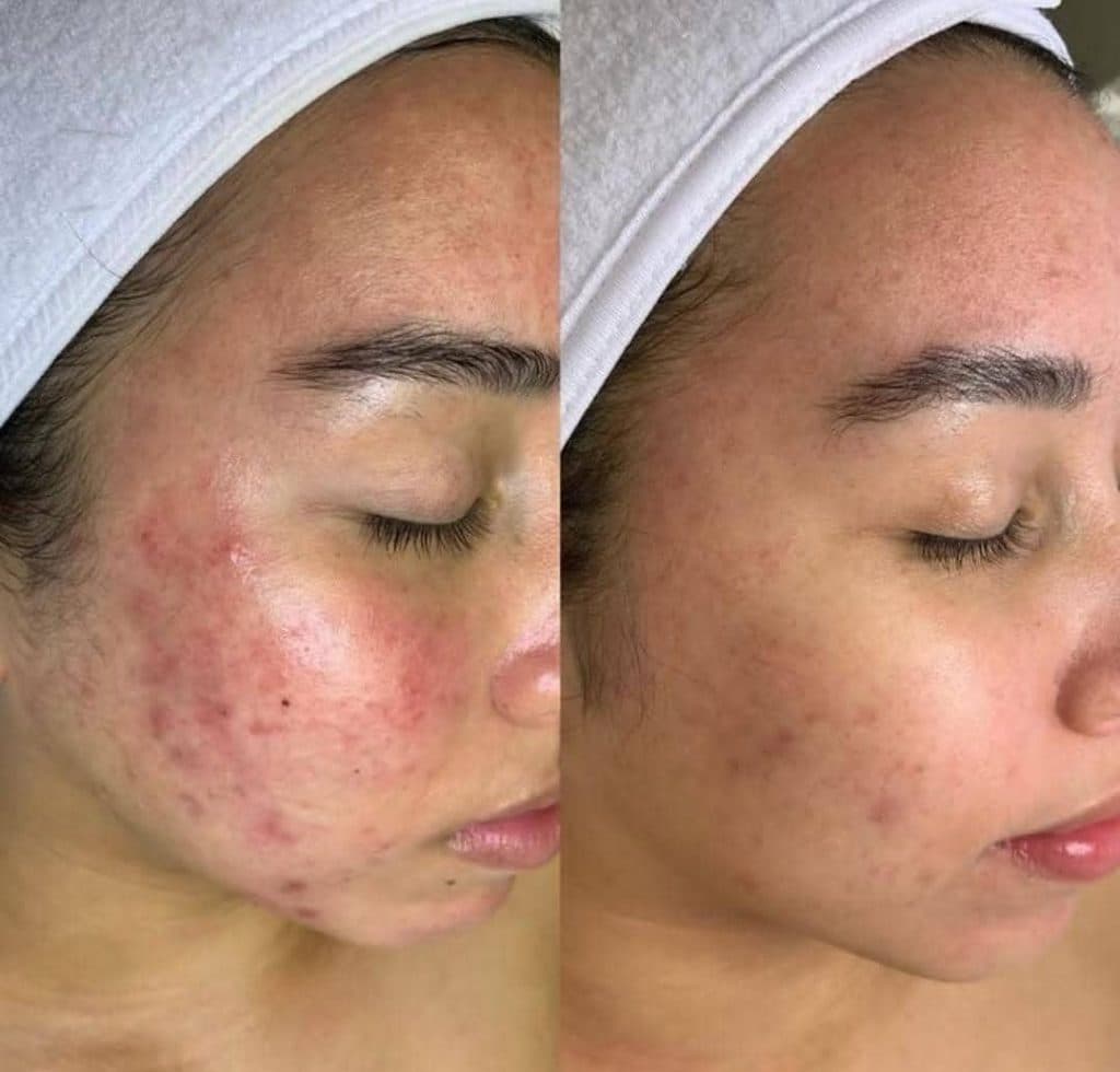 آموزش و خدمات تخصصی پاکسازی پوست و فشیال صورت هدیه تقویان در مشهد