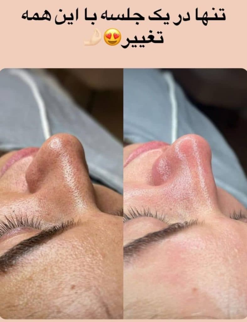 آموزش و خدمات تخصصی پاکسازی پوست و فشیال صورت هدیه تقویان در مشهد