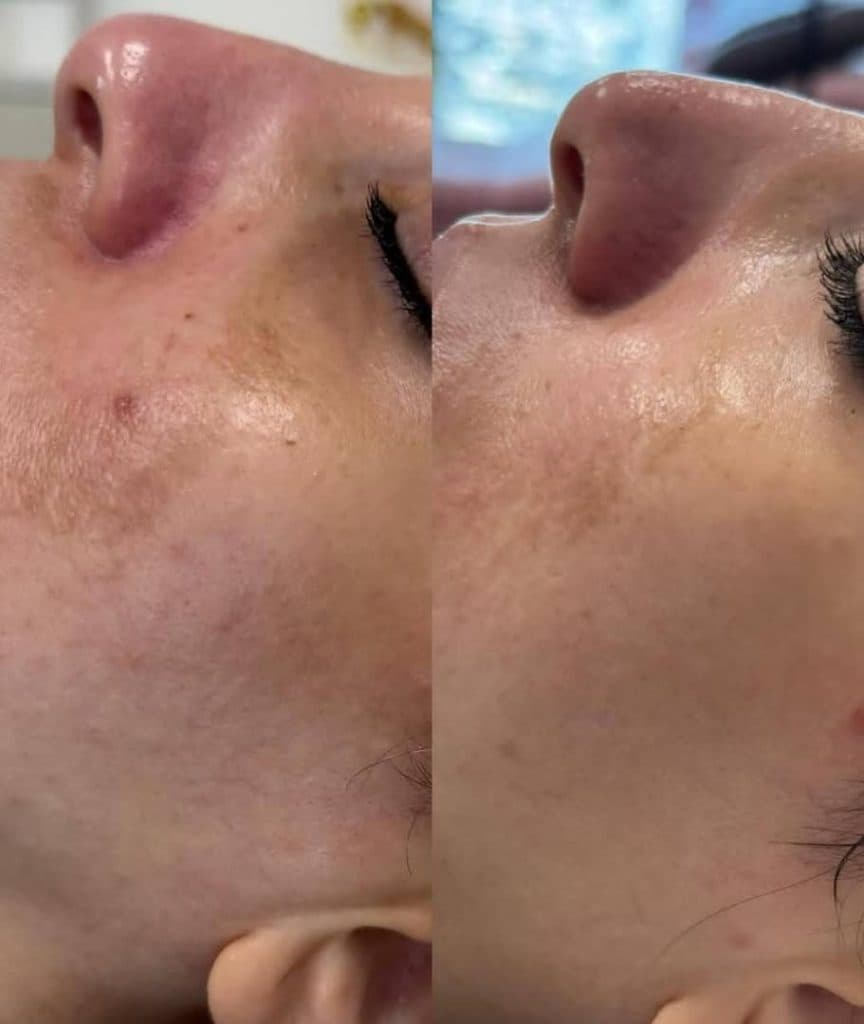 آموزش و خدمات تخصصی پاکسازی پوست و فشیال صورت هدیه تقویان در مشهد