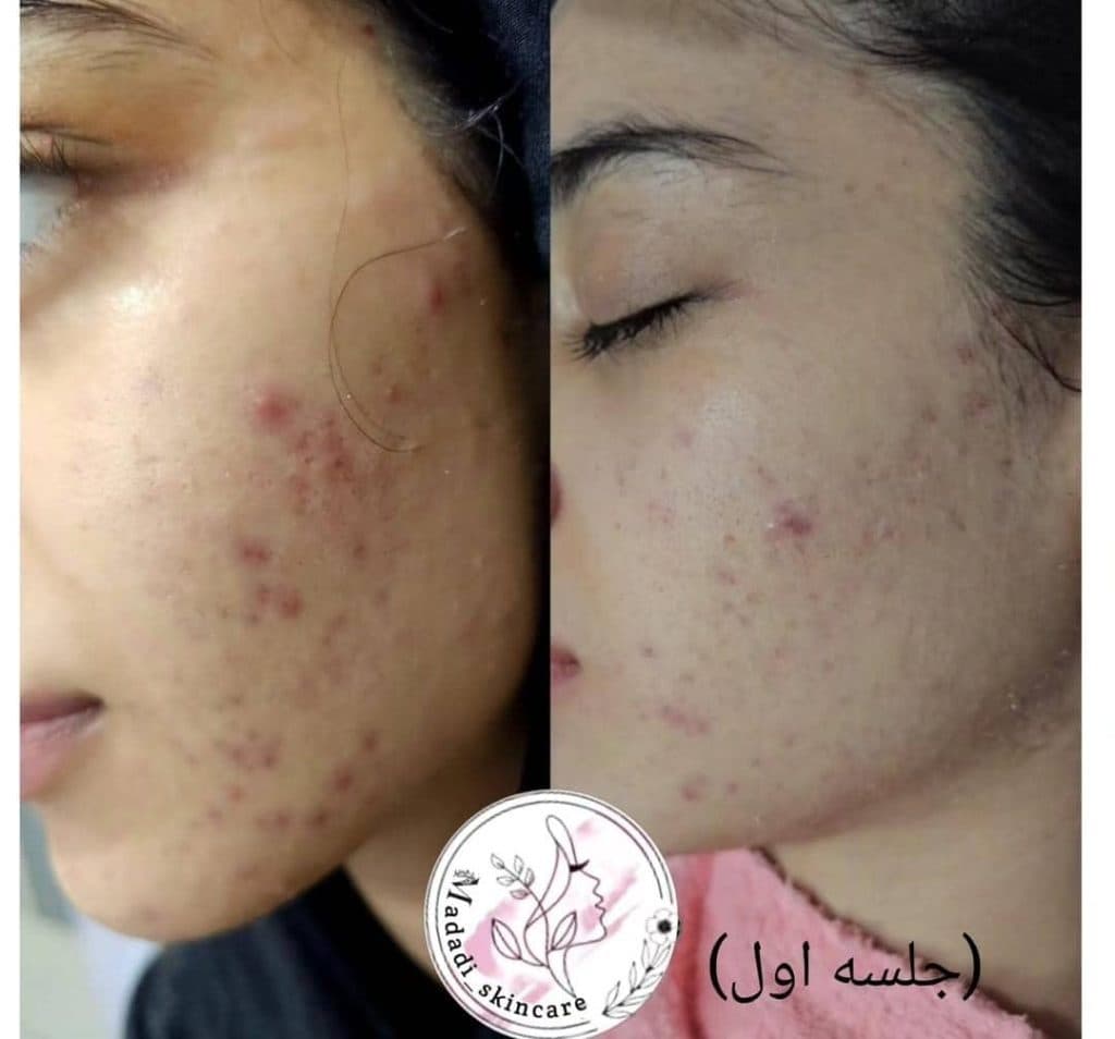 خدمات تخصصی فیشیال درمان لک و جوش زهرا مددی در کرمان