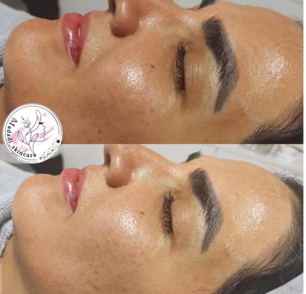 خدمات تخصصی فیشیال درمان لک و جوش زهرا مددی در کرمان