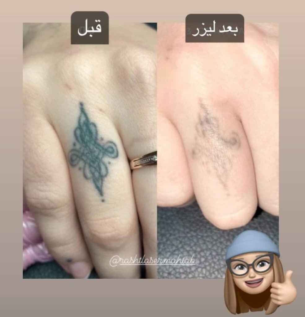 مرکز تخصصی ریموو تاتو مهتاب در گلسار رشت