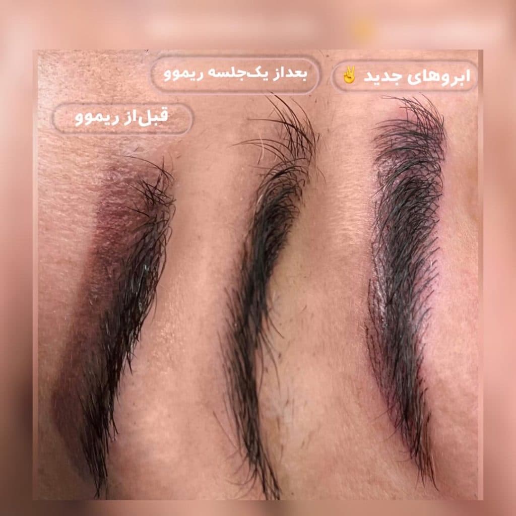 ریمو و تتوی صورت سحر ثانی رشت